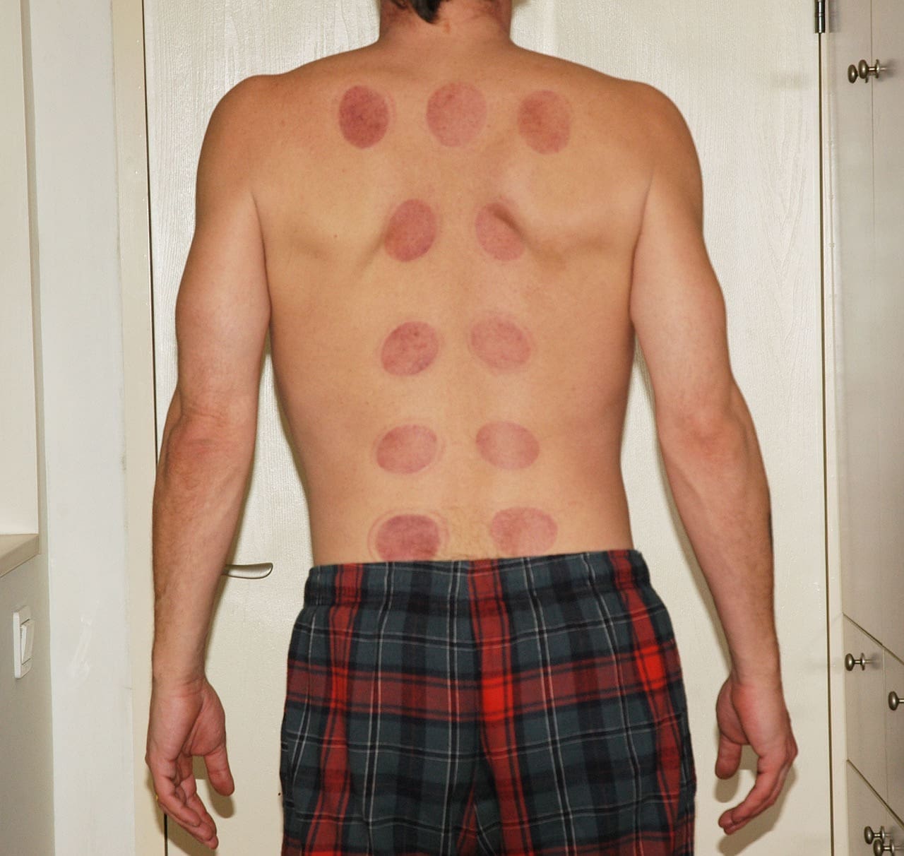 Acupuncture: The Key to Relieving Chronic Fatigue Syndrome? Acupuncture: The Key to Relieving Chronic Fatigue Syndrome?