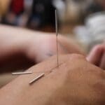 Acupuncture for Stress Relief: Say Goodbye to Anxiety Acupuncture for Stress Relief: Say Goodbye to Anxiety