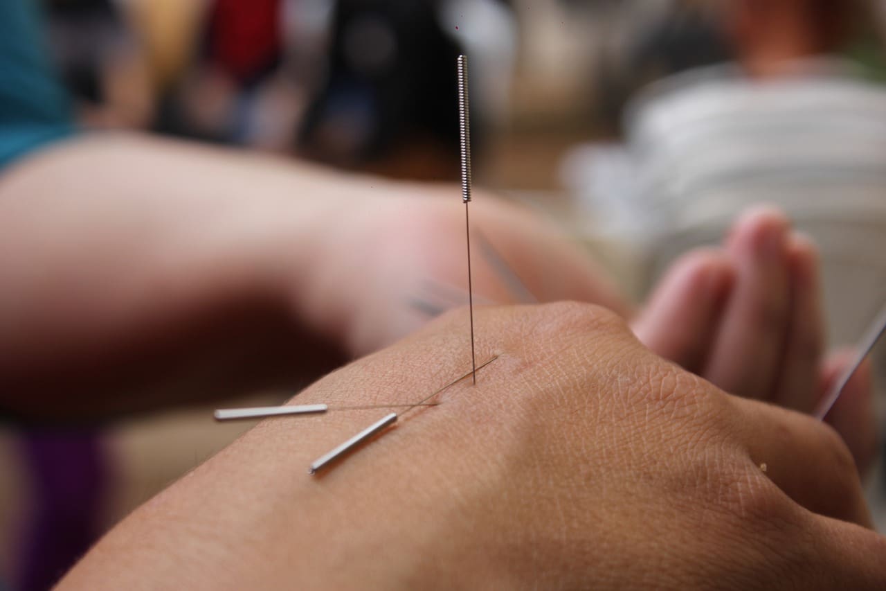 How Acupuncture Can Help You Quit Smoking: Here’s What You Need to Know How Acupuncture Can Help You Quit Smoking: Here’s What You Need to Know