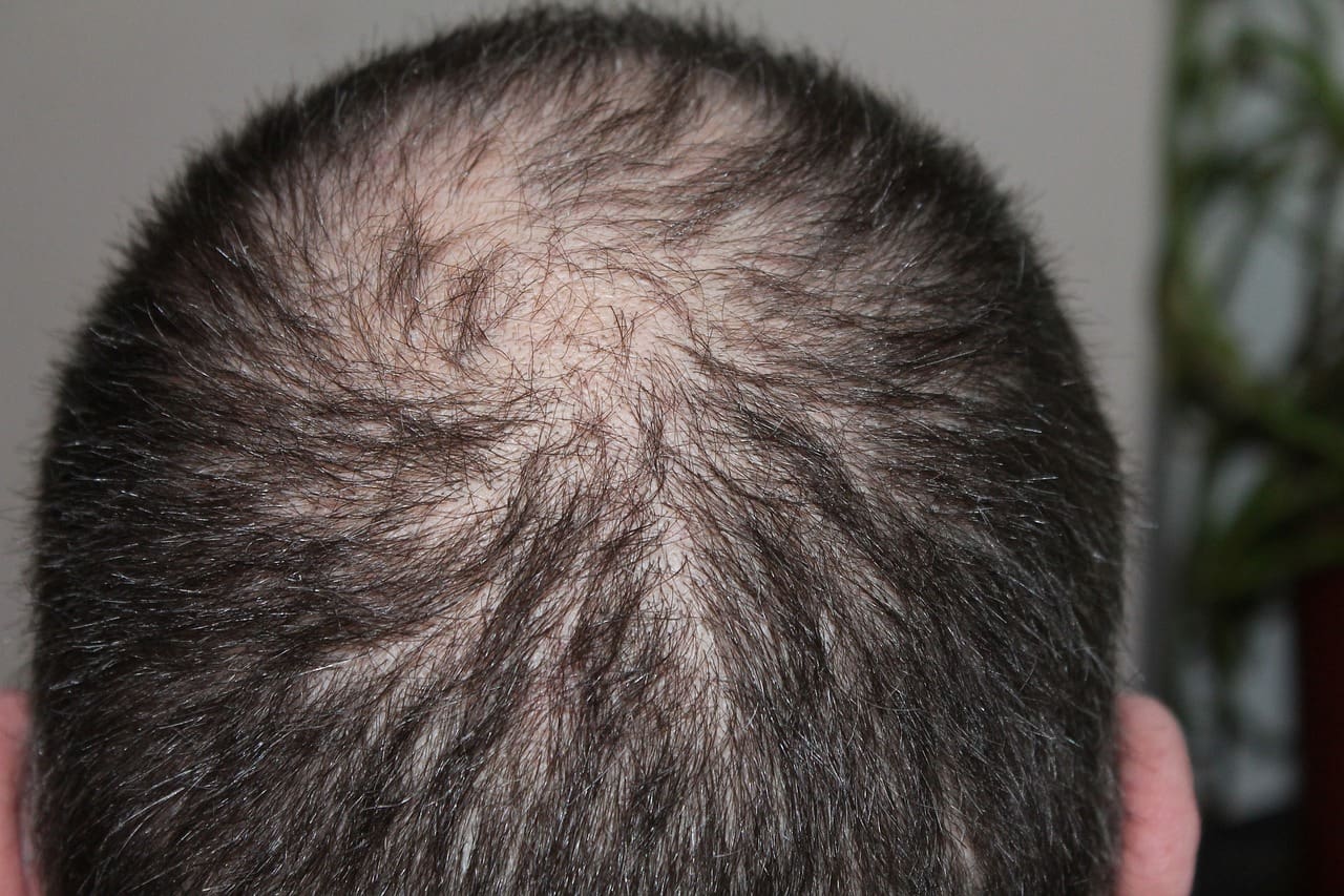 Say Goodbye to Hair Loss Anxiety: Simple Coping Strategies Say Goodbye to Hair Loss Anxiety: Simple Coping Strategies