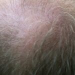 Hair Loss: A Journey of Empowerment and Self-Discovery Hair Loss: A Journey of Empowerment and Self-Discovery