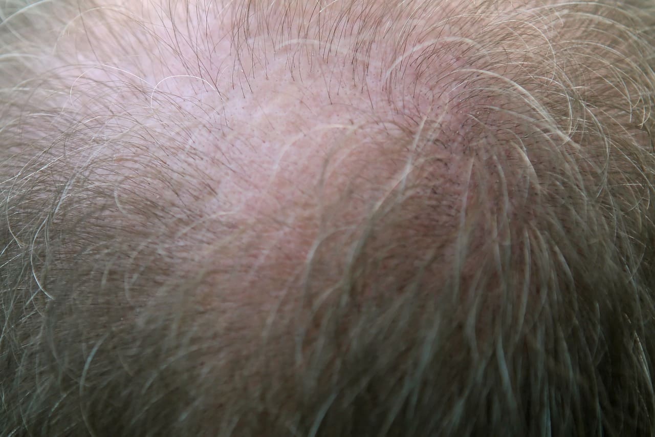 Hair Loss as a Symptom: Unveiling Underlying Health Issues Hair Loss as a Symptom: Unveiling Underlying Health Issues