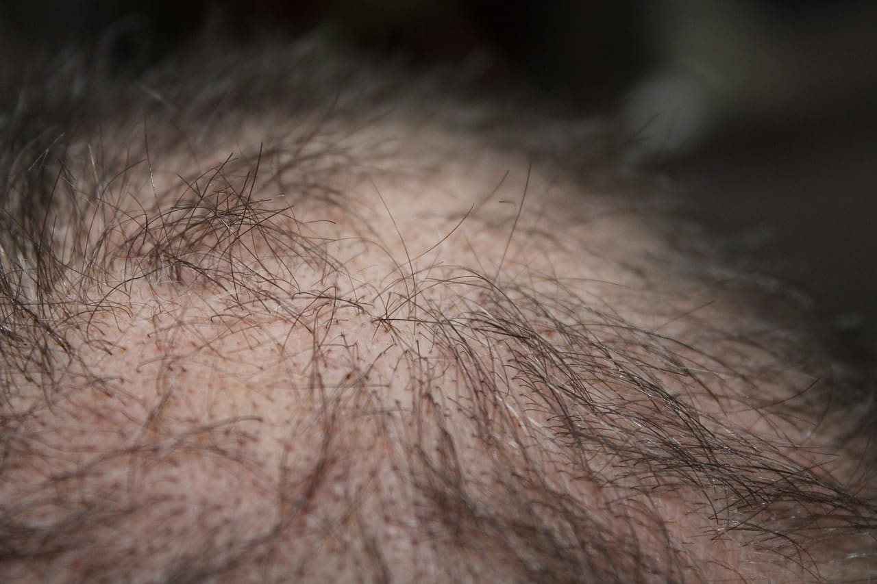 Reclaim Your Confidence: Overcoming Hair Loss Stigma Reclaim Your Confidence: Overcoming Hair Loss Stigma
