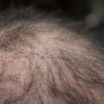 Don’t Let Hair Loss Define You: Embrace Your True Beauty Don’t Let Hair Loss Define You: Embrace Your True Beauty