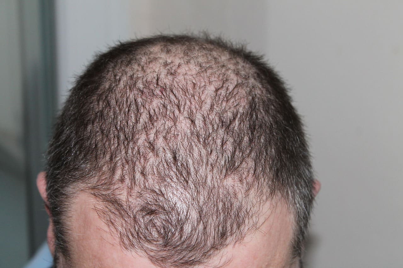 The Impact of Hair Loss on Self-Esteem: A Personal Story The Impact of Hair Loss on Self-Esteem: A Personal Story